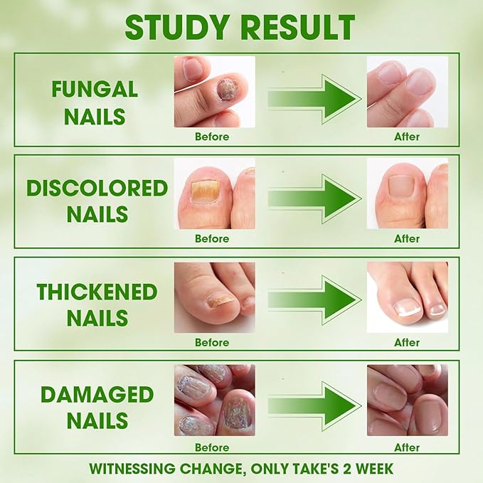 Toenail Fungus Treatment Extra Strength, 7 Days Nail FungusTreatment for Toenail - Pure Natural Plant Extracts, Toe Nail Fungus Treatments for Athletes Foot, Thick, Broken, Discolored & Damaged Nail