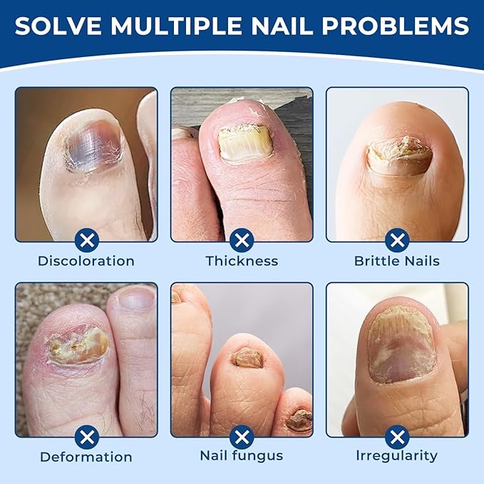 Toenail Fungus Treatment Extra Strength - 32 Pcs Fungal Nail Patches, 8-Hour Nighttime Renewal Toenail Fungus Patches for Damaged Nails and Appearance of Discolored