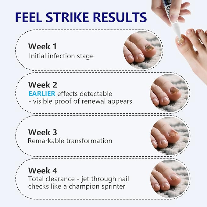 iKeener Toe Nail Fungus Treatment Pen - 25% Undecylenic Acid, Tea Tree Oil Extra Strength for Toenails and Fingernails, 0.4 Fl Oz (Pack of 4)