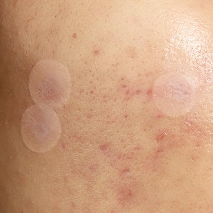 Julep Patch Me Up Waterproof Pimple Patches for Face – 72 Hydrocolloid Clear Acne Patches with Tea Tree Oil, Ultra-Thin Acne Stickers, Reduces Blemishes & Scarring – 48 8mm & 24 12mm Patches