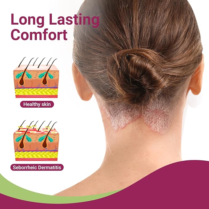 ishancare Seborrheic Dermatitis Cream, Maximum Strength Treatment for Psoriasis, Folliculitis, Dermatitis, Dandruff, Fast Relief for Itching, Redness, Irritation, Scaling, 3.53 Oz