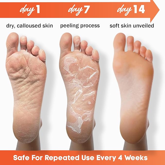 Foot Peeling Mask – Lavender Exfoliating Treatment Booties for Callus Removal & Renewal of Dry, Cracked Feet – Dermatologist-Inspired Moisturizing Spa Therapy for Men & Women (Peach 2 Pairs)