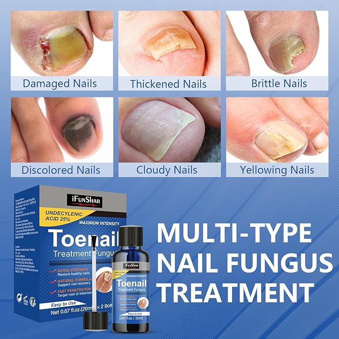 Toenail Fungus Treatment Extra Strength, Nail Fungus Treatment with 25% Undecylenic Acid, Upgraded Fungal Nail Repair for Yellow, Discolored, Thick and Ingrown Nails, 2 Bottles