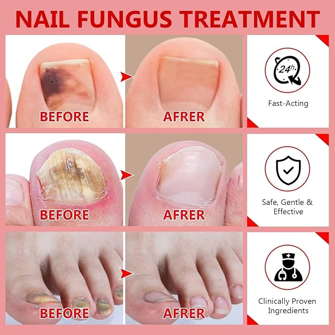Toenail Fungus Treatment Extra Strength, Nail Fungus Treatment for Toenail, Natural Plant Extracts Toe Nail Fungus Treatments for Athletes Foot