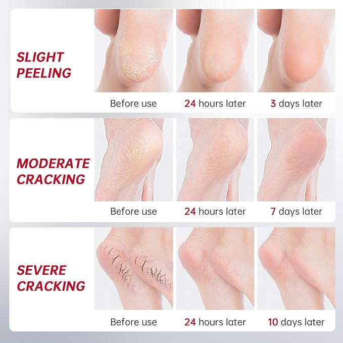 Urea Cream 40 Percent for Feet Maximum Strength, with Heel Protectors, Foot Moisturizer Cream for Dry Cracked Heels Rough Dead Dry Skin Foot Callus Remover - 5.29 Oz