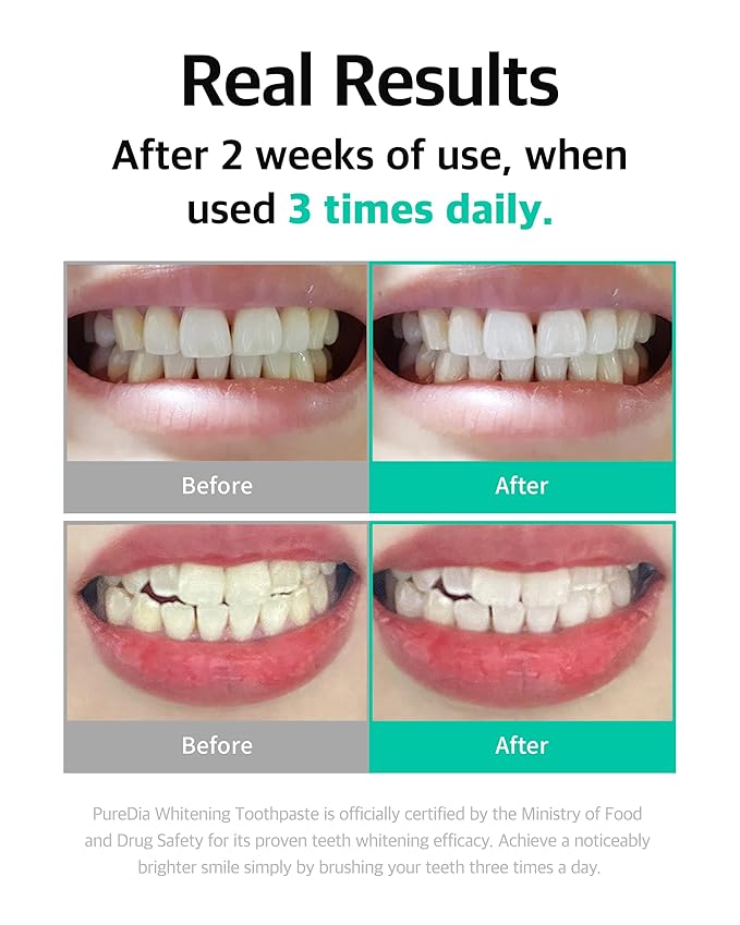 Live Orals Whitening Toothpaste 80g x 5 Units - Fluoride-Free, Nano Hydroxyapatite & Hydrogen Peroxide, Sensitive Teeth, Enamel Strengthening, Natural Mint Gel