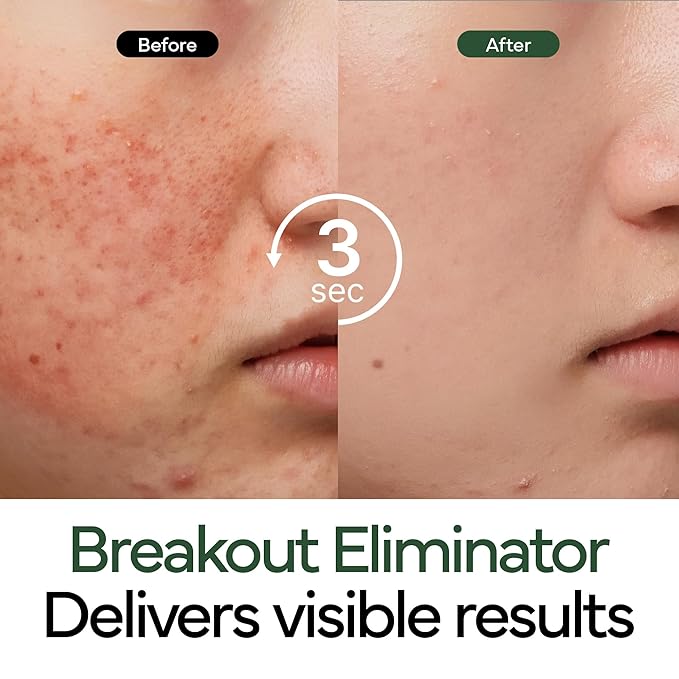 Intensive Cica Repair Cream, Korean Dexpanthenol cream, Restore Skin Barrier, Prevent Acne Breakouts, Ultra-Soothing & Hydrating Care Cream for Sensitive Skin with Madecassoside (1.76oz / 50g)