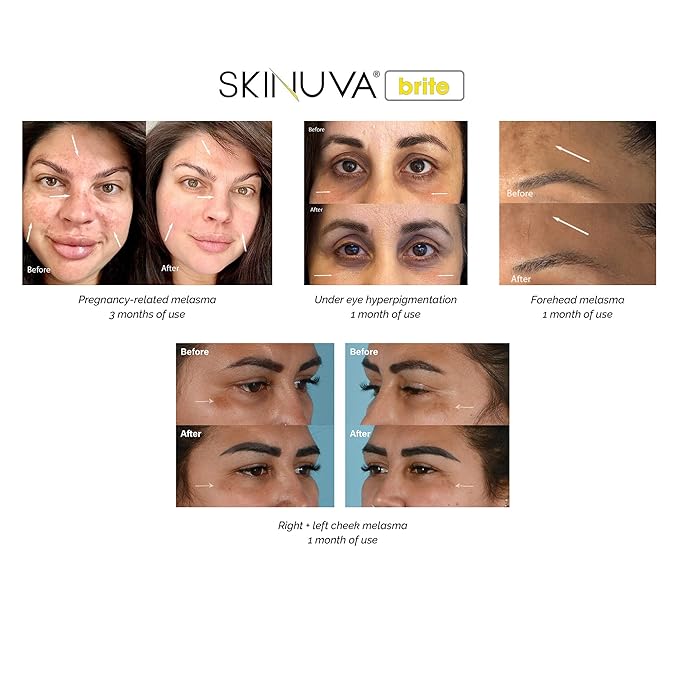 Skinuva® Brite Dark Spot Treatment – Tone-Enhancing Cream Formulated with Growth Factors, Vitamin C, and Niacinamide For All Skin Types