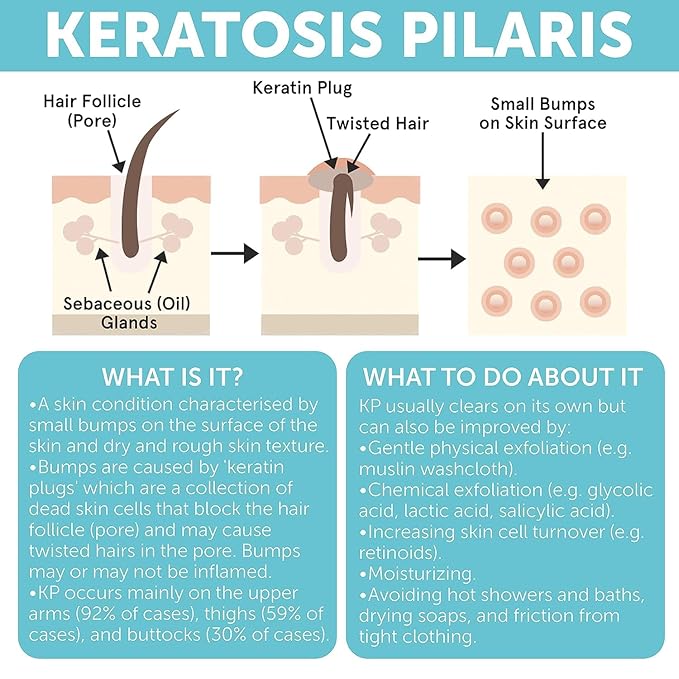 Keratosis Pilaris Treatment | Keratosis Pilaris Lotion | KP Lotion | Gentle Exfoliation For Strawberry Legs, KP & Ingrown Hairs | Smooth & Hydrating Body Lotion For Redness, Dry, Rough And Flaky Skin