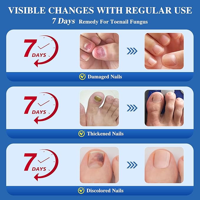 Toenail Fungus Treatment Extra Strength - Effective Antifungal Nail Repair Solution with Tea Tree Oil for Toenail & Nail Fungus, Fast Acting Treatment for Damaged Nails & Ingrown Toenail - 60ml/2fl oz