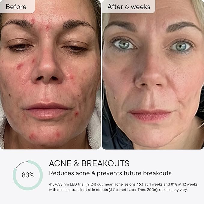 Qure Red Light Therapy for Face – LED Mask with 5 Light Modes for Anti-Aging, Acne, Wrinkles & Dark Spots, 3-Min Wireless Daily Treatments, Smart App Control with Reminders, FDA Cleared