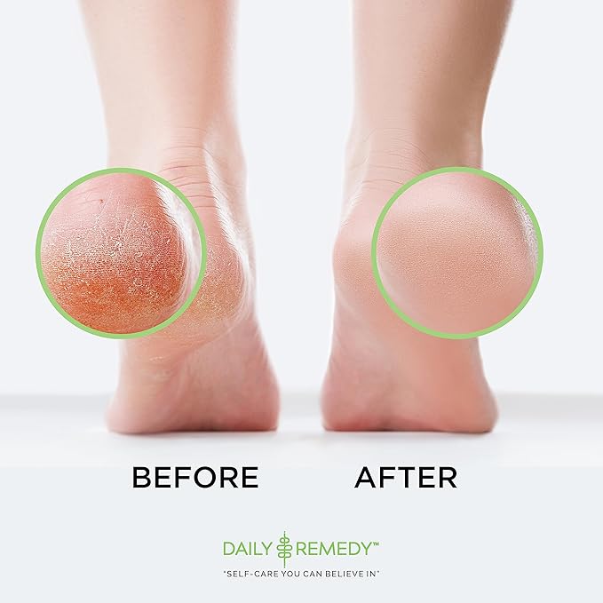 DAILY REMEDY EXTRA STRENGTH Tea Tree Oil Foot Soak w/ Epsom Salt Made in USA Toenails，Athlete's Foot，Itchy Feet，Stubborn Smelly Foot Odor，Pedicure Calluses & Soothes Sore Tired Achy Feet 16 oz，Black