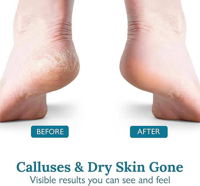 Gilden Tree Foot Callus Remover Kit - 40% Urea Cream & Handmade Terra-Cotta Pumice Stone for Feet - Callus Remover for Feet with Shea Butter & Aloe Vera - Cracked Heel Treatment & Moisturizer