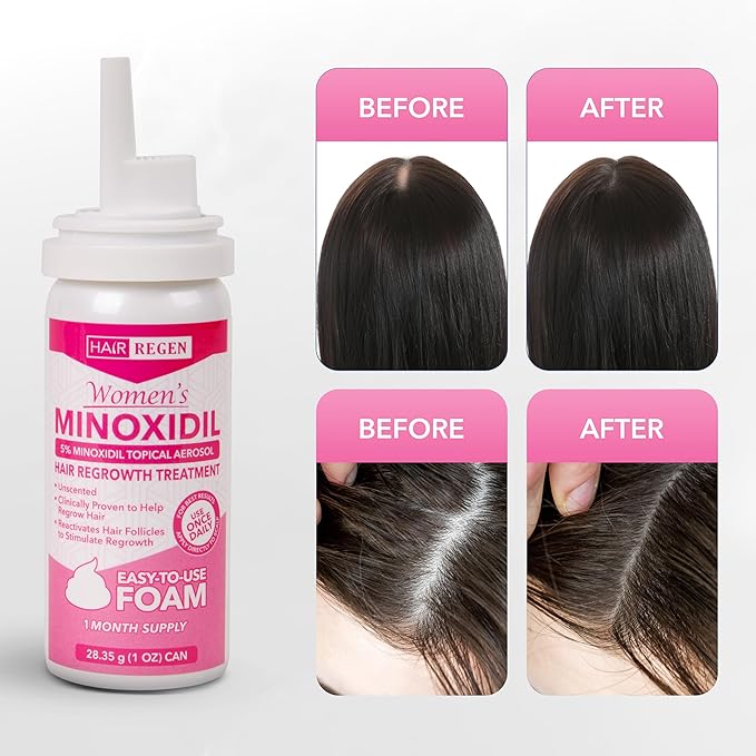 Minoxidil Foam for Women 5% Percent - Women's Hair Growth Treatment for Her - Topical Foaming Minoxidil for Women - Great for Hair Regrowth and Reduce Hair Loss - 6 Pack as 6 Month Supply