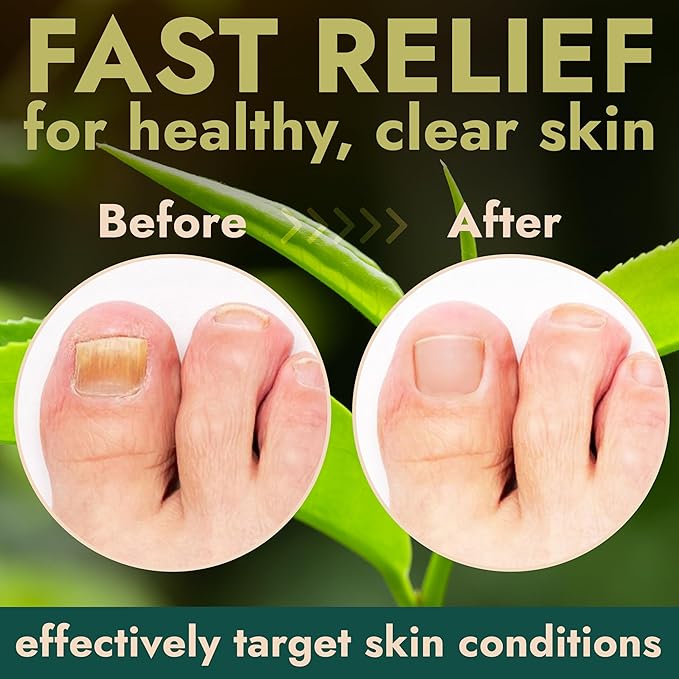 Toenail Fungus Pen - Tea Tree Oil for Toenail Fungus - Antifungal Nail Treatment with Tea Tree Oil - Fast-Acting, No-Touch Applicator - Restores Thickness & Discoloration - 20ML Volume
