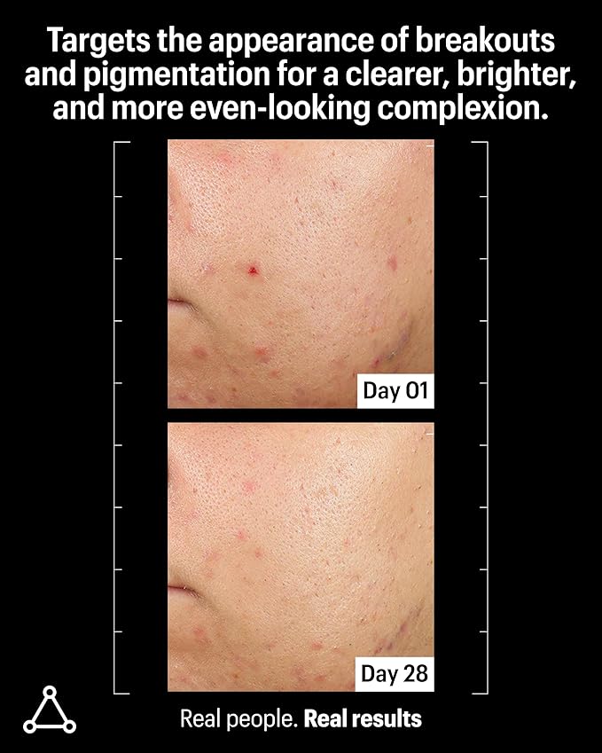 Allies of Skin Azelaic & Kojic Clarifying Face Serum | Clinically Proven for Acne & Blemish Prone Skin |10% Azelaic Acid Treats Pigmentation and Redness | Targets Pores & Uneven Skin Texture (1 Fl oz)