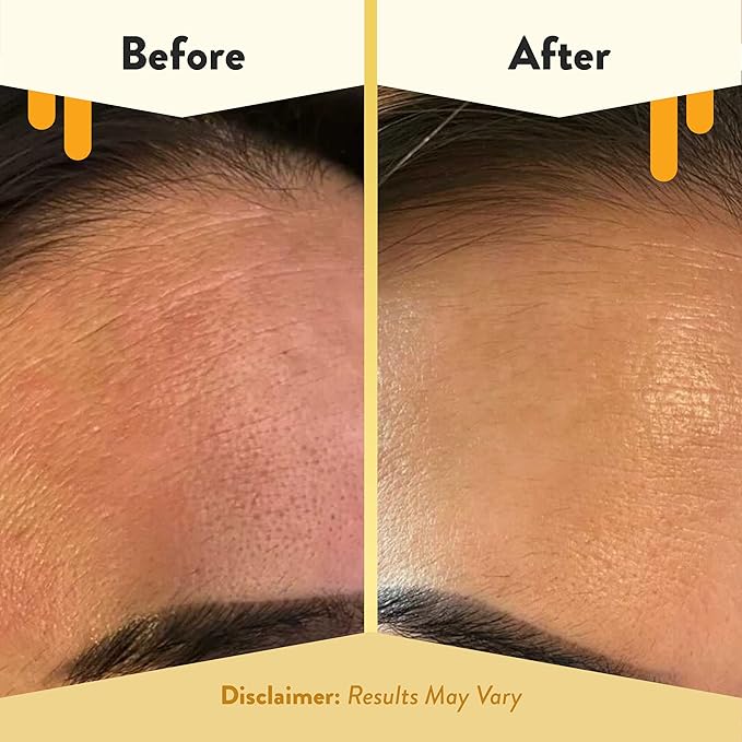 ECZEMA HONEY Nourishing Face Serum - Daily Hydrating Serum - Face Oil for Eczema, Dry & Sensitive Skin (1 Oz)