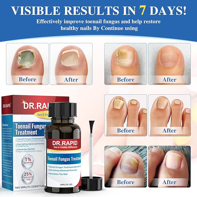 Toenail Fungus Treatment Extra Strength - Effective Antifungal Nail Repair Solution with Tea Tree Oil for Toenail & Nail Fungus, Fast Acting Treatment for Damaged Nails & Ingrown Toenail - 30ml/1fl oz