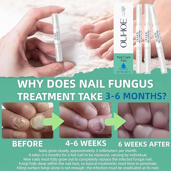 Nail Fungus Pen，Nail Growth & Repair Essence Pen, specifically designed for fungal infections on toenails and fingernails. Repairs and strengthens nails, revealing smooth and glossy nails（3pcs）