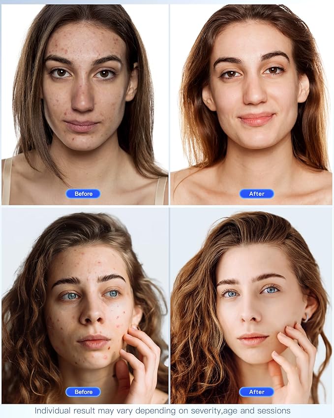 NEWKEY LED Face Mask Light Therapy,Red Light Therapy for Face Wrinkle Blue Light Therapy Mask for Face Acne,150LEDs,10 Min Auto Shut off, Wired