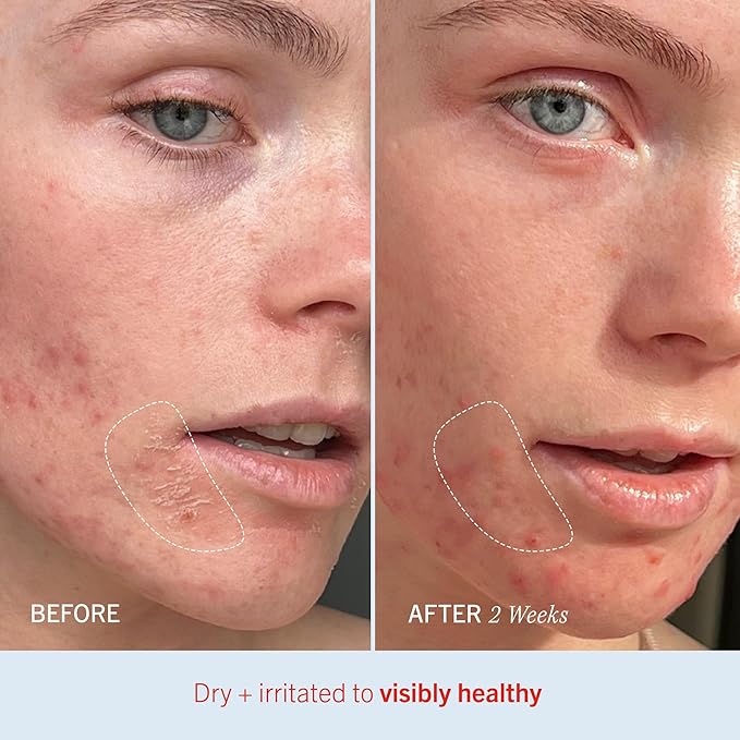 First Aid Beauty - Ultra Repair Cream, Intense Hydration Whipped Colloidal Oatmeal, Clinically Proven to Strengthen Skin Barrier in 7 Days & Helps Relieve Eczema, Luxury Moisturizer, 6 oz + Bonus, 2ct