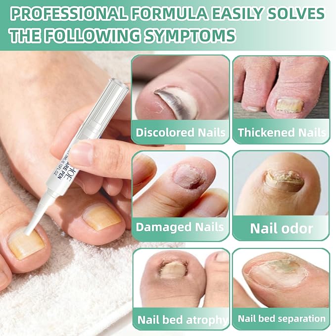 Nail Fungus Pen，Nail Growth & Repair Essence Pen, specifically designed for fungal infections on toenails and fingernails. Repairs and strengthens nails, revealing smooth and glossy nails（3pcs）