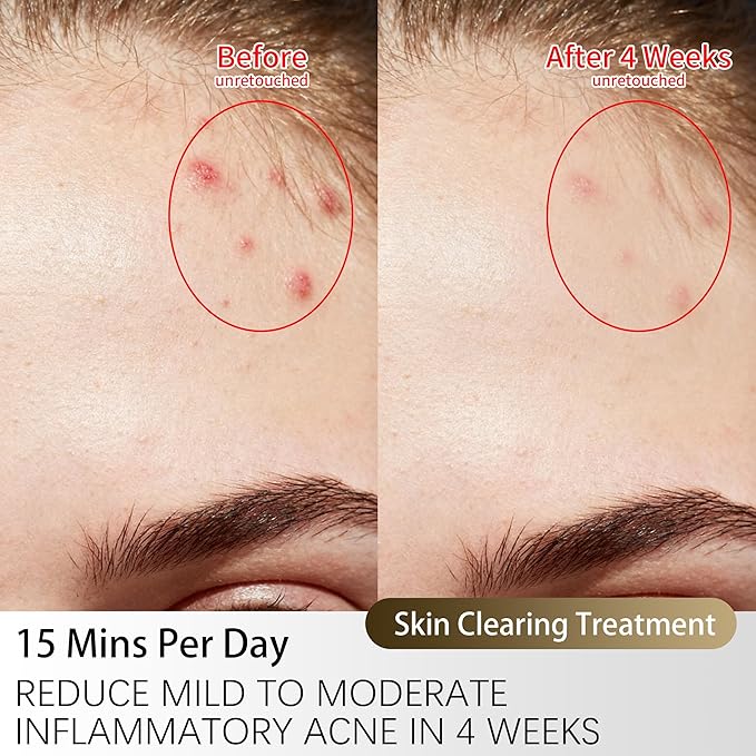 TASNEEM Red Light Therapy for Face, 3D Red Light Therapy Face Mask with 328 LEDs for Full-face Wrinkles & Acne, Red & Blue Infrared LED Light Therapy Mask with 3 Modes, FDA-Cleared, Remote Control