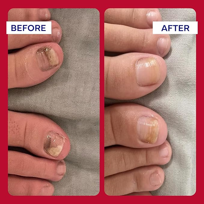 EMUAIDMAX Homeopathic Psoriasis Scalp Treatment Serum – Natural First Aid Concentrate for Dry, Itchy Scalp Relief and Skin Irritations from Psoriasis, Eczema, and Dermatitis, 1oz