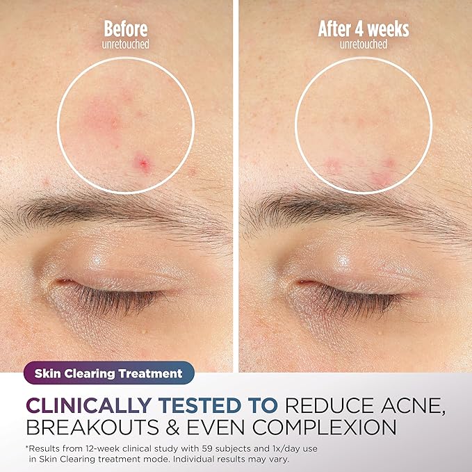 Shark CryoGlow LED Face Mask with Under-Eye Cooling, Anti-Ageing & Blemish Repair, Red & Blue LED, Infrared Light Therapy, USB-C, Remote Control, Storage Bag, Lilac Chill, FW312PL